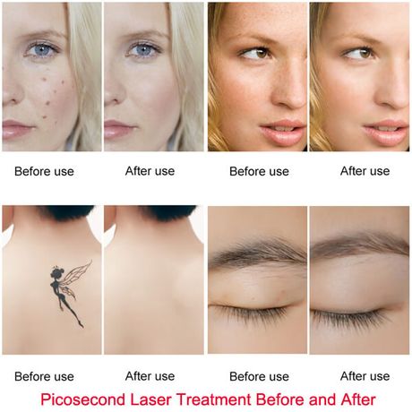 Why Choose Picosecond Laser Treatment-1