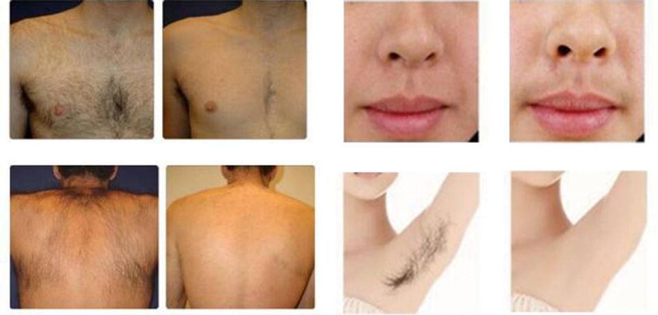 Permanent laser hair removal technology-1