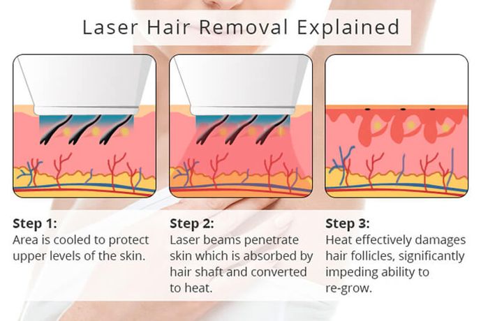 Permanent laser hair removal technology-2