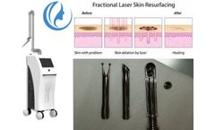 CO2 laser treatment for acne scars
