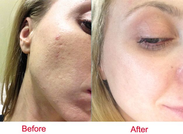 CO2 laser treatment for acne scars-3