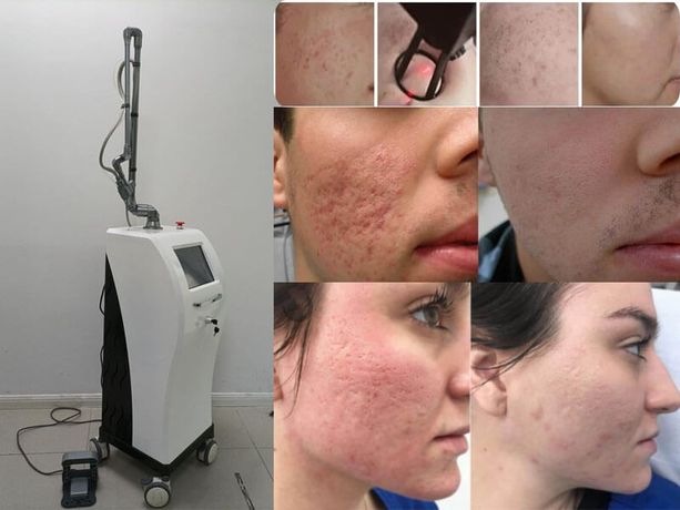 CO2 laser treatment for acne scars-1