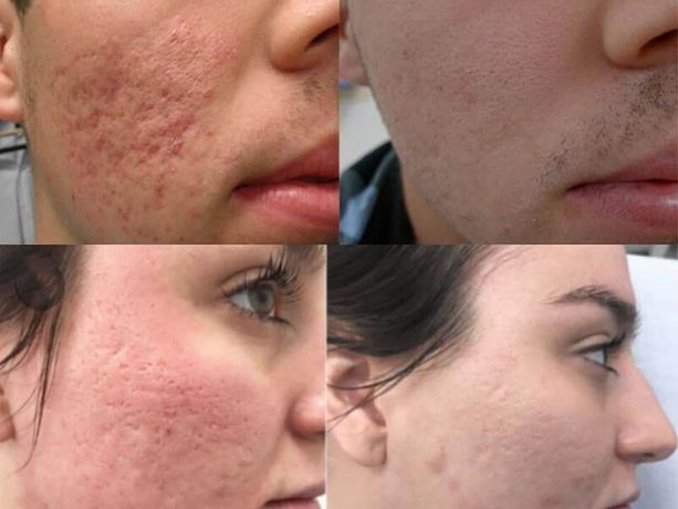 What skin problems can CO2 fractional laser solve-2