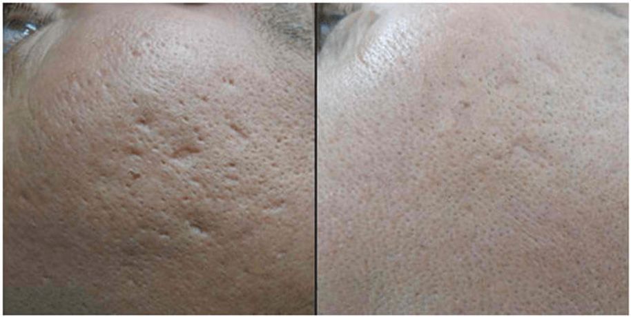 What skin problems can CO2 fractional laser solve-3