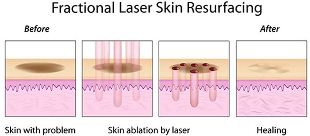 Classification of Fractional Lasers-1