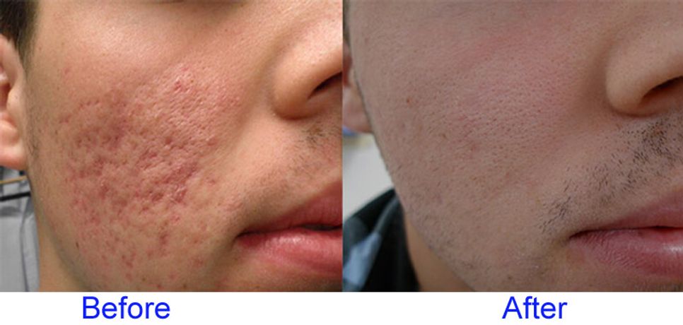 The CO2 fractional laser skin resurfacing in action-3