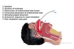 Complications of Nasal Endotracheal Intubation - Video
