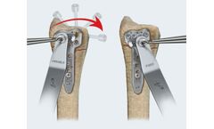 Avanti - Distal Radius Fracture Fixation