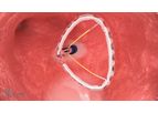 Helios Valcare - Novel Mitral Valve Replacement