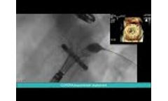 Valcare Mitral Valve Replacement System - Video