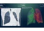 Myrian - Version XP-Lung and XP-Lung Nodule - Automatic Segmentation and Analysis Tools