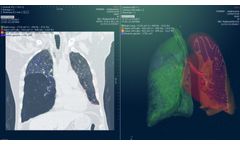 Myrian - Version XP-Lung and XP-Lung Nodule - Automatic Segmentation and Analysis Tools