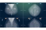 Myrian - Version XP-Breast, XP-Mammo and XP-Female Pelvis - Mammography, Tomosynthesis, Breast MRI Or Ultrasound Examinations