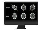 NeuroQuant - Version CT - Fast and Accurate Automated Post-Processing Software for Head CTs