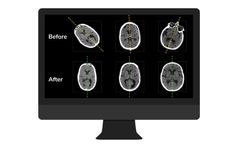 NeuroQuant - Version CT - Fast and Accurate Automated Post-Processing Software for Head CTs