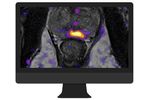 OnQ Prostate - Breakthrough Software Supporting Improved Prostate Cancer Detection