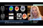 Quantitative Imaging for Dementia - Case review with Dr. Bash - Video