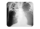 Menssana - Breath Tests for Pulmonary Tuberculosis