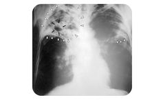 Menssana - Breath Tests for Pulmonary Tuberculosis