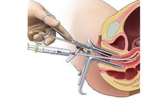 Gynecological Technology for Office-Based Uterine Access