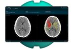 Brainomix - Version e-ASPECTS - Transforming Stroke Care Through Simple Imaging