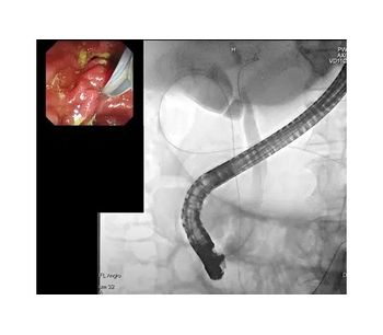 Diagnostic ERCP Software of Image Analysis and AI