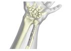 TriMed - Ulnar Osteotomy Compression Plate