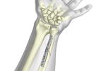 TriMed - Ulnar Osteotomy Compression Plate