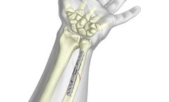 TriMed - Ulnar Osteotomy Compression Plate