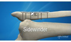 TriMed`s Sidewinder is used to treat Weber B, short oblique fibula fractures without lag screws! - Video