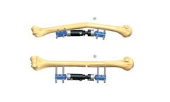 Orthofix - Model 1E.21 - Midshaft Deformity of Humerus In Children or Small Adults