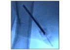 Marxman - Deflective Bone Marrow Aspiration System
