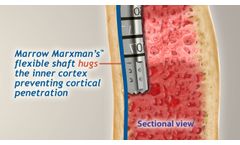 Marrow Marxman Anterior Procedure Animated - Video