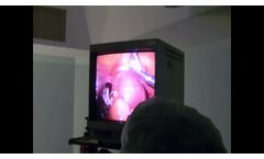 Laparoscopic Ovarian Cyst HR - Video