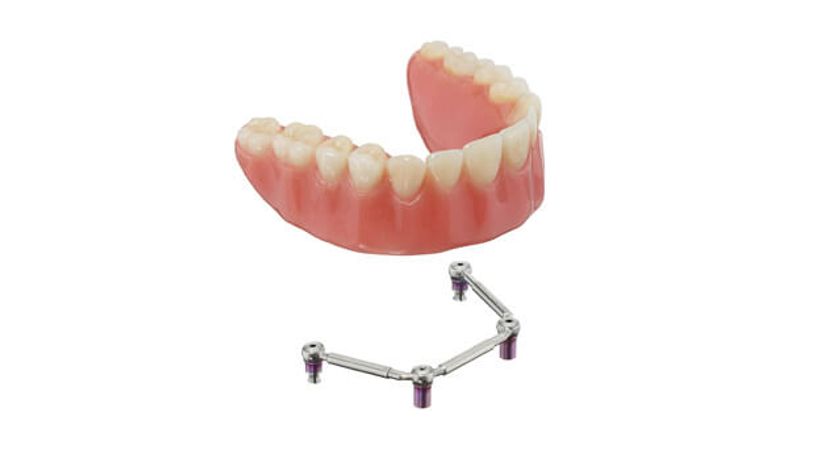 Dental implants Prothetics
