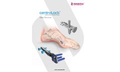 Novastep Centrolock - Guided Transverse Osteotomy System - Brochure