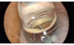 Stent placement in glaucoma surgery - Recorded with MicroREC - Video
