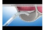 Sinus Floor Elevation (Geistlich Biomaterials Patient Information) - Video