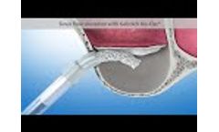 Sinus Floor Elevation (Geistlich Biomaterials Patient Information) - Video