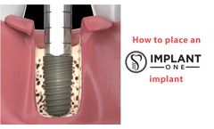 How to Place an Implant One Implant, Animated - Video