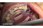 MGUIDE with C1 B+ Implants - Video