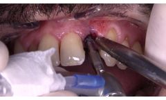 Immediate implantation and loading after extraction on lateral incisor - Video