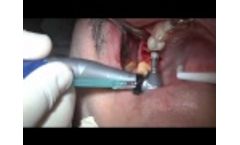 Immediate Placement MIS SEVEN Implants - Live Surgery - Video