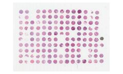 TriStar - Model TA3124 - IO Multi Tumor Array 1 (TA3124): Breast Cancer ER+, Her2+, TNBC, NSCLC(SCC), NSCLC(ADC), Lung (SCLC) with histopath data