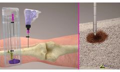 OmniBone Bone Biopsy Kit with Power - Video