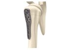 Miraclus - Model ASLP - Proximal Humerus Plate System