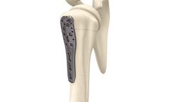 Miraclus - Model ASLP - Proximal Humerus Plate System