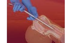 Tracheal Stent Delivery - Cares - Video