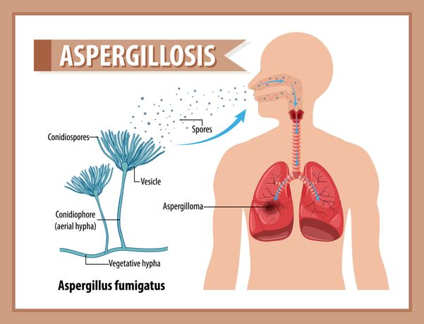 Aspergillus Infection Risks in Hospitals, Homes and Buildings-1