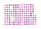 TriStar - Model TA3089 - Hematological Cancers: MZL, FL, MCL, CLL/SLL, DLBCL, Hodgkin’s Lymphoma with histopath data  1mm